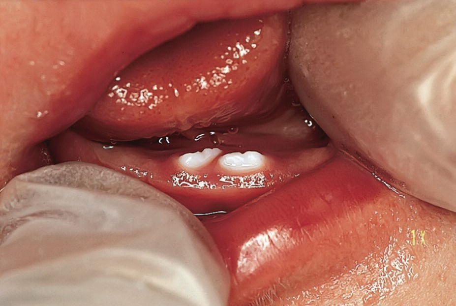Photo displaying natal teeth in a 2-day-old girl.