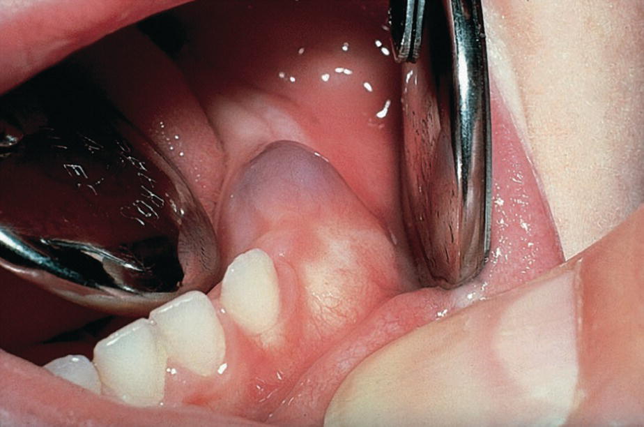 Photo displaying fibrous gingival tissue delaying eruption of primary molars.