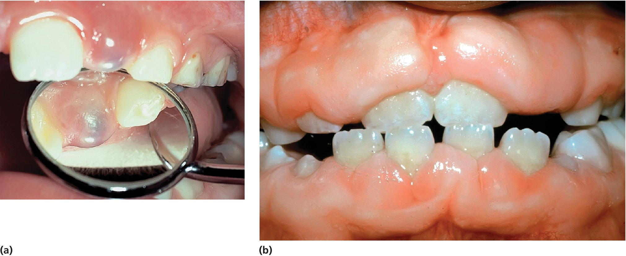Photos of eruption cyst (a), and gingival overgrowth caused by phenytoin medication influencing tooth eruption (b).