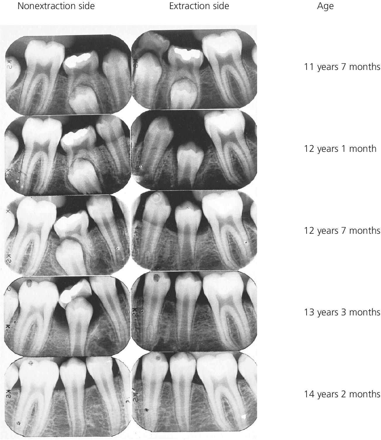 Radiographs of infraoclusion of primary molars of a boy from 11 years 7 months to 14 years 2 months of age displaying nonextraction (left) and extraction sides (right).