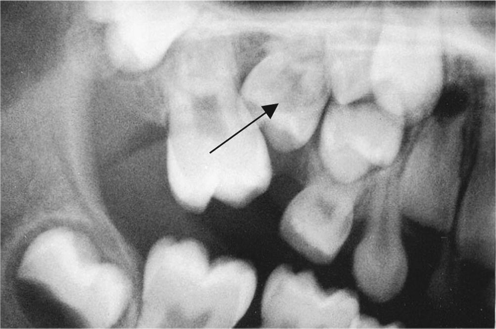 Radiograph of impacted primary maxillary second molar causing eruption disturbances for permanent premolars indicated by arrow.