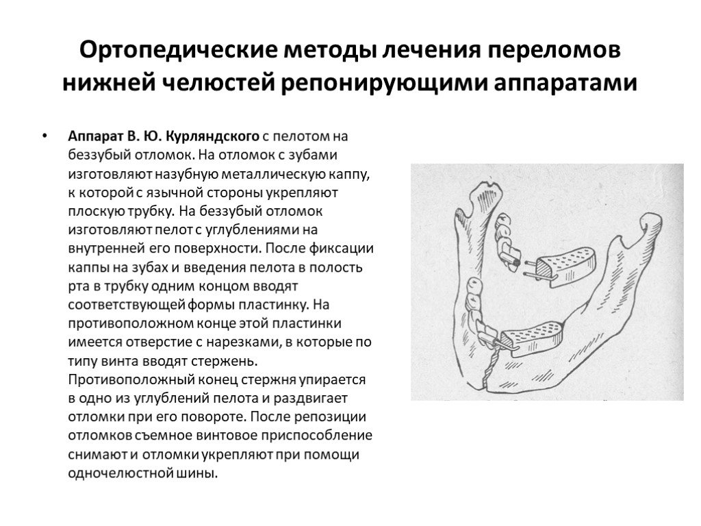 Нижняя терапия. Ортопедические методы лечения переломов нижней челюсти. Ортопедический метод лечения перелома верхней челюсти. Ортопедические методы лечения переломов верхней и нижней челюстей. Аппараты для лечения переломов нижней челюсти.