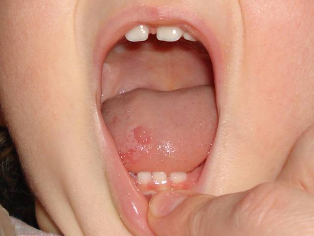 Симптомы и лечение вирусного стоматита у детей