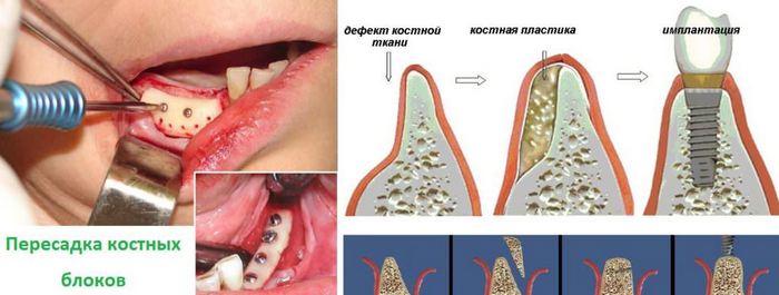 Протезирование или имплантация зубов