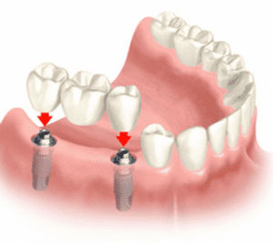 Протезирование или имплантация зубов