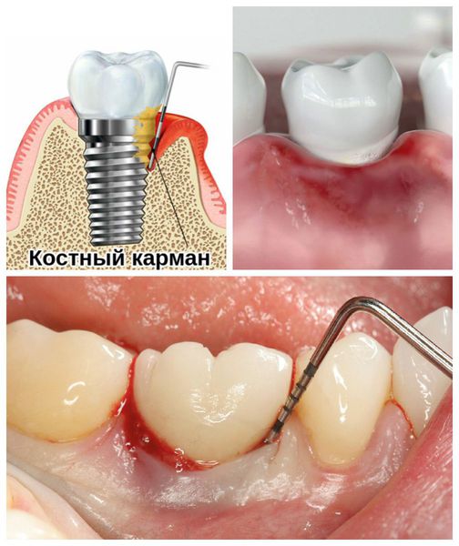 Что такое карман у зуба фото