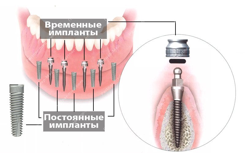 временные импланты при имплантации зубов, фиксация временного протеза на импланты