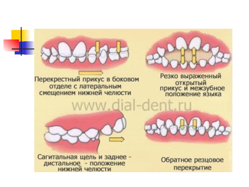 Аномалии Зубов Фото