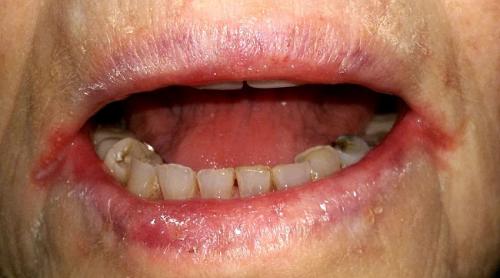Трещины в уголках губ причины и лечение у взрослых. 11 причин трещин в уголках рта и их лечение