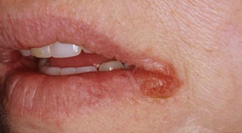 Трещины в уголках губ причины и лечение у взрослых. 11 причин трещин в уголках рта и их лечение