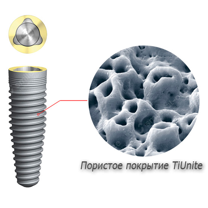 Уникальное покрытие зубных имплантов Nobel Biocare TiUnite