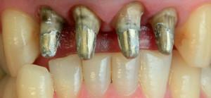 Как делают зуб c помощью штифта и какой вид лучше: стекловолоконный, анкерный или металлический?