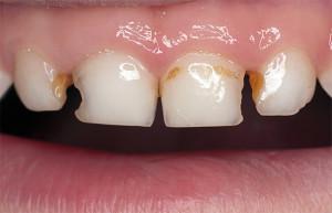 Причины кариеса молочных зубов у детей раннего возраста и способы лечения с фото