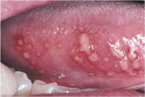 Стоматит, волдыри и болячки под языком: схема лечения в зависимости от причины возникновения язв