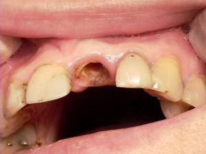 Как нарастить зуб, если остался только корень, и можно ли восстановить разрушенную коронку с одной стенкой?