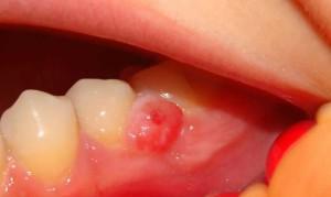 Почему в дырке или между зубами выросла десна что делать и как это лечить?