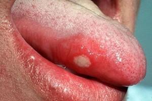 Стоматит, волдыри и болячки под языком: схема лечения в зависимости от причины возникновения язв