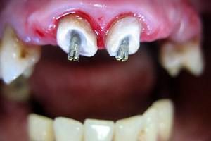 Как делают зуб c помощью штифта и какой вид лучше: стекловолоконный, анкерный или металлический?