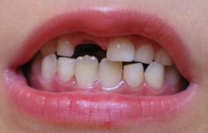 Прорезывание и рост первых зубов у детей: как режутся молочные зубки у грудничков до года порядок и фото