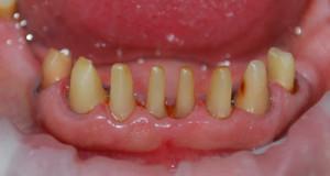 Больно ли обтачивать зуб под металлокерамическую коронку, как происходит препарирование?