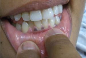 Почему у взрослого и ребенка вокруг зуба на десне может появиться черная точка?