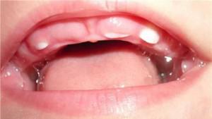 Сколько дней могут прорезываться первые зубы у ребенка, в каком возрасте это происходит?