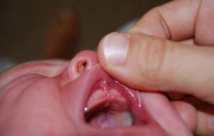 Что делать, если ребенок порвал уздечку между десной и верхней губой к какому врачу обращаться?