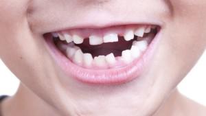 Порядок и симптомы прорезывания коренных зубов у детей: смена молочного прикуса на постоянный с фото