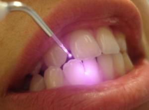 Электрофорез, УВЧ-терапия и другие виды физиолечения в стоматологии: особенности проведения процедур, польза для зубов