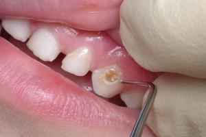 Причины кариеса молочных зубов у детей раннего возраста и способы лечения с фото