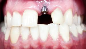 Как нарастить зуб, если остался только корень, и можно ли восстановить разрушенную коронку с одной стенкой?