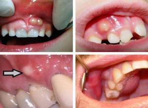 Симптомы периостита зуба с фото, лечение воспаления надкостницы нижней или верхней челюсти