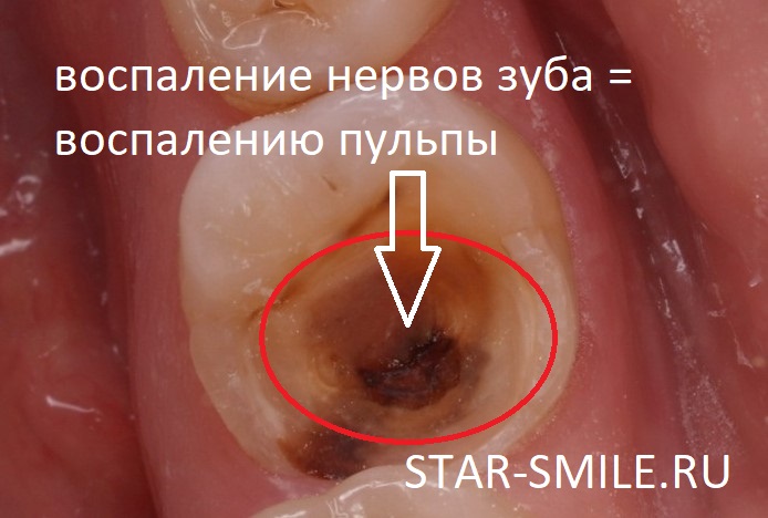Воспаление нервов зуба = воспалению пульпы