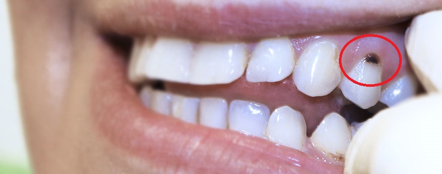 Пришеечный кариес зубов