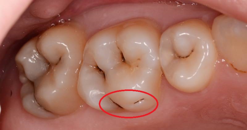 Кариес на боковой поверхности зуба