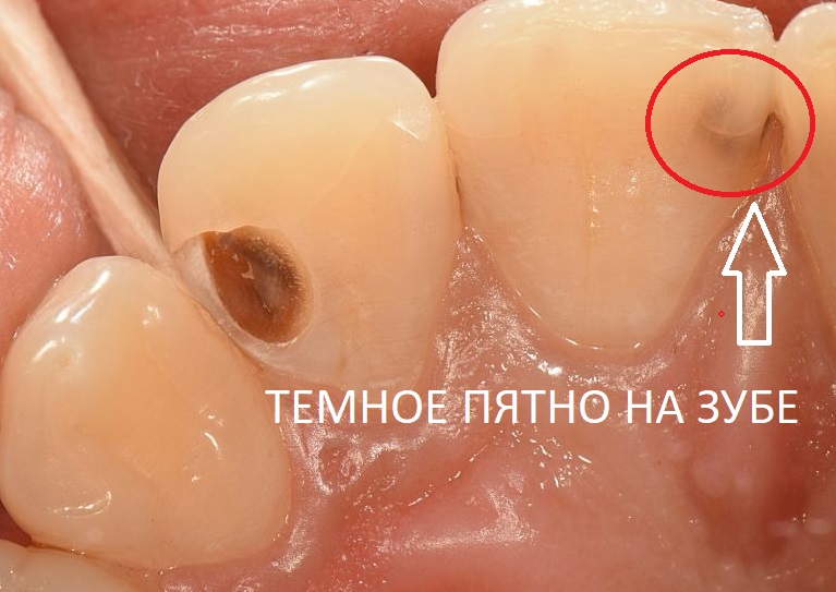 Третья стадия кариеса - темное пятно на зубе