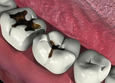 Новые варианты при лечении глубокого кариеса