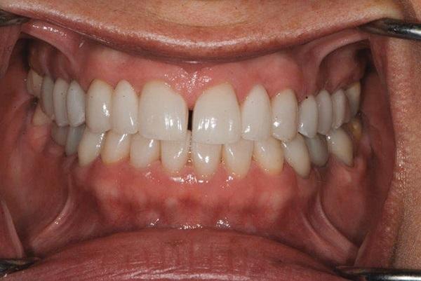 Ортодонтическая интрузия: клинические возможности использования