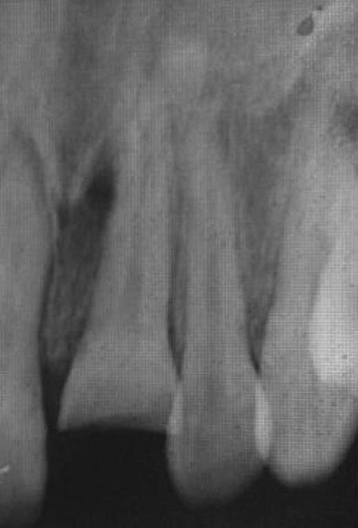 Клинический случай интрузии зуба