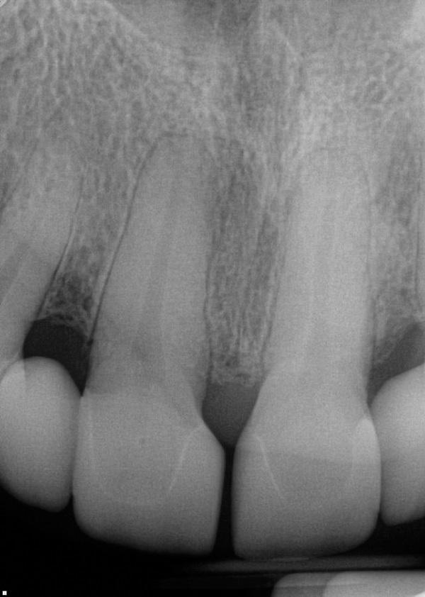 Ортодонтическая интрузия: клинические возможности использования