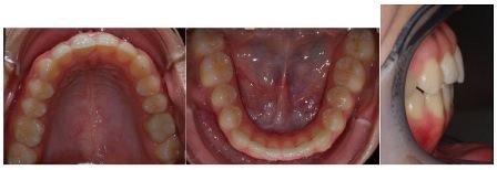 Нехирургическое ортодонтическое лечение открытого прикуса у взрослого пациента
