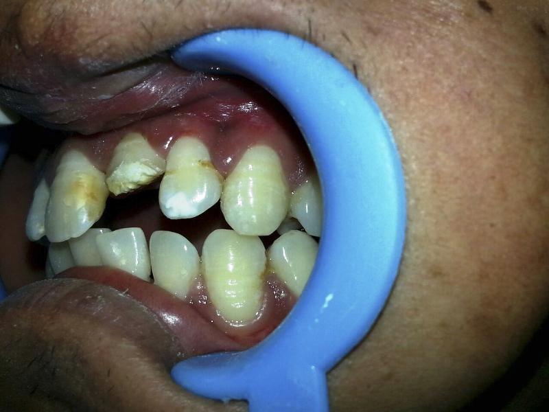 Клинический случай интрузии зуба