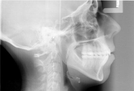 Нехирургическое ортодонтическое лечение открытого прикуса у взрослого пациента