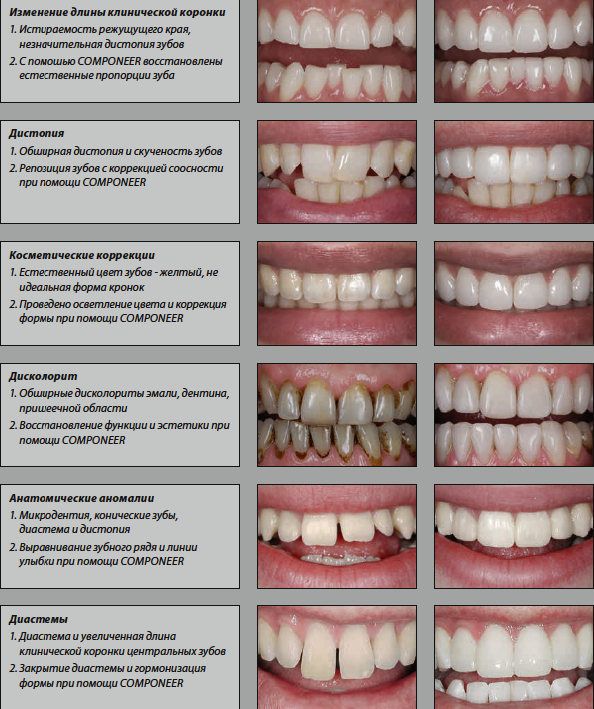 Какие зубы можно ставить. Дисколорит зубов тетрациклиновые зубы. Высота фронтальных зубов.