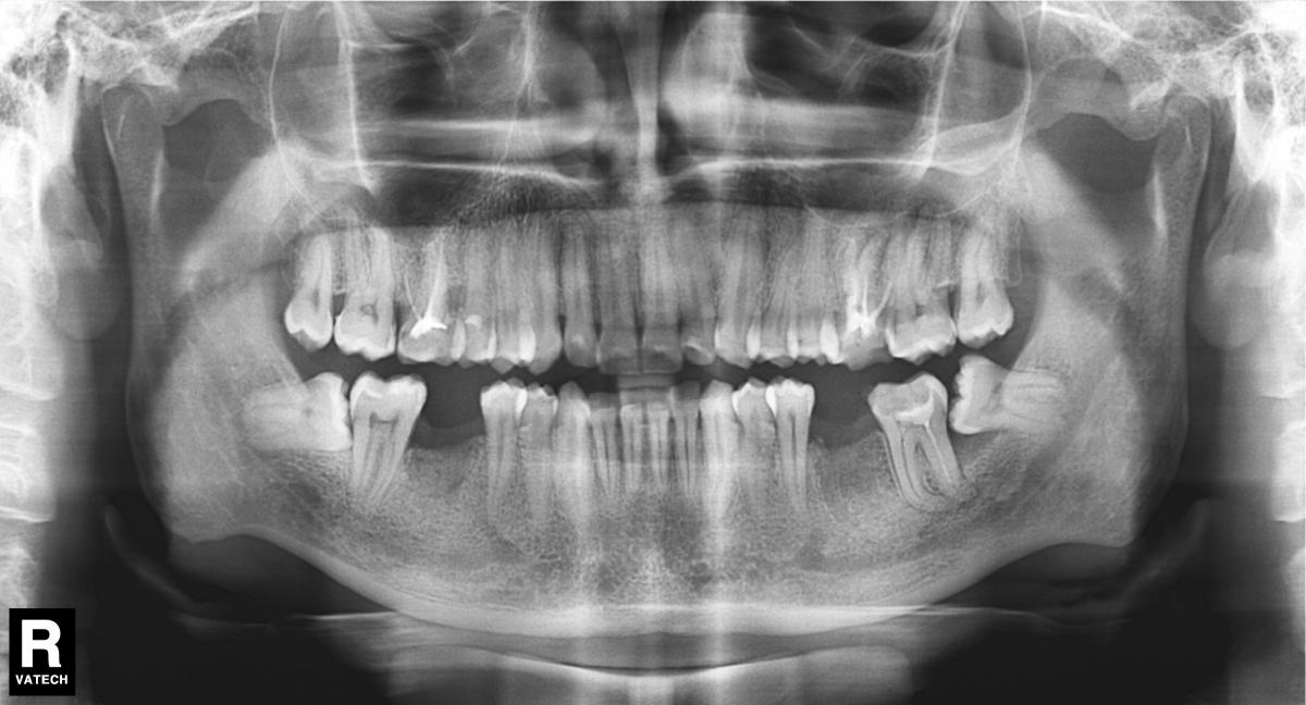 Панорамный снимок челюсти. Пародонтит панорамный снимок. Тетрациклиновые зубы ортопантомограмма. Ортопантомограмма клинический случай. Панорамный снимок на фотобумаге.
