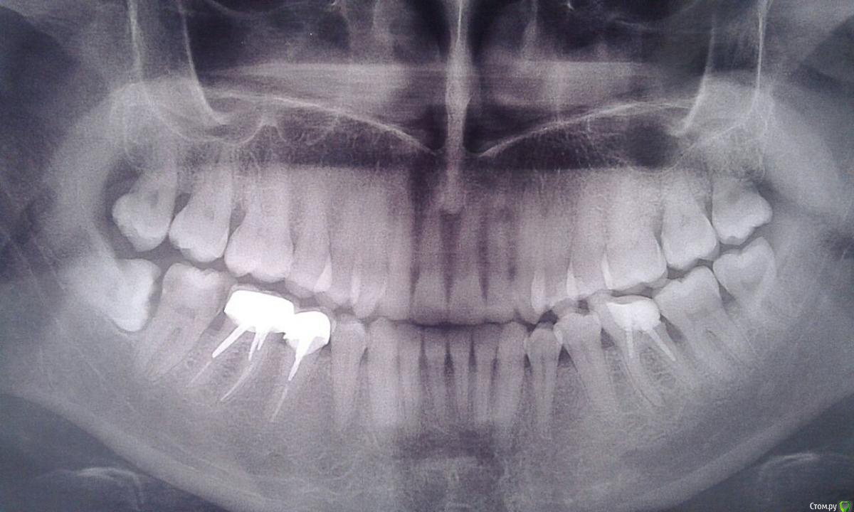Ретенирование зуба. Ретинированный 8 зуб рентген. Ретинированный дистопированный зуб мудрости. Ретенция и дистопия зуба.
