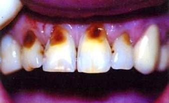 Клиническая симптоматика некроза твердых тканей зуба