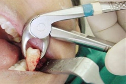 Повреждение других зубов в процессе удаления
