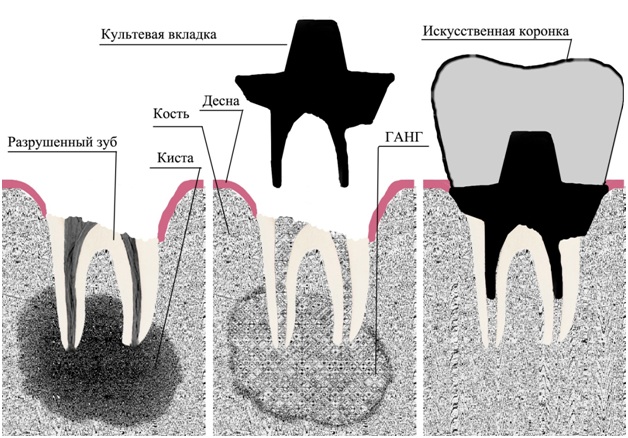 Ставить ли коронку. Внутрикорневая культевая вкладка. Коронка зуба вкладка схема. Культевая вкладка на корень под коронку. Корень-культевая вкладка- коронка.