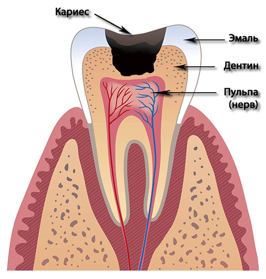Болит зуб после лечения кариеса. Строение зуба кариес пульпит. Глубокий кариес пульпит. Пульпит кариозная полость.